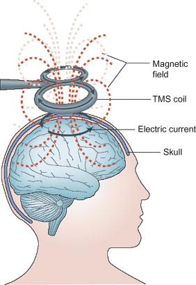 rTMS therapy services in karachi